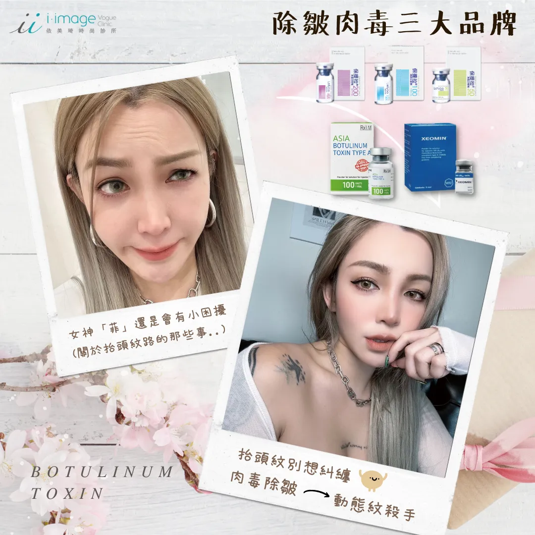 肉毒抬頭紋